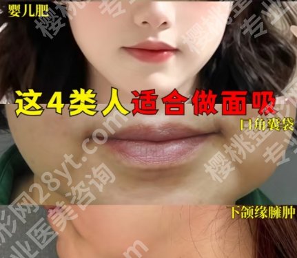 南京面部吸脂比较有名的医生推荐！闻可、陈勇、李国伟等都是技术流！