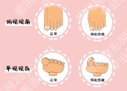 陈圣英医生大脚骨做得怎么样？圣嘉新专家实力测评！