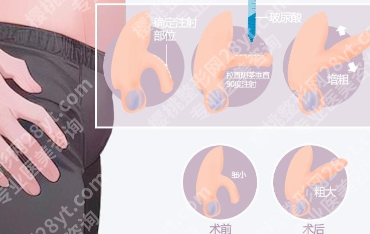 青岛男性增粗手术费用贵不贵？价目表|医院名单附上！