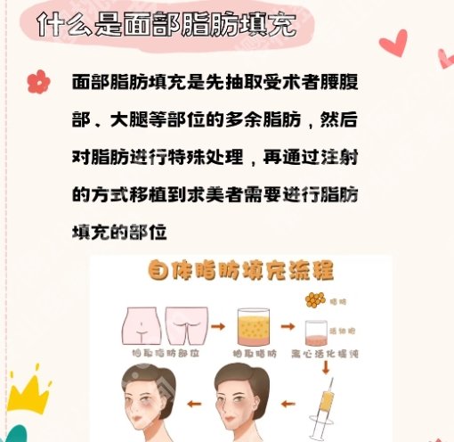 斯楼斌做全脸脂肪填充的费用相关介绍！院内明星项目介绍！