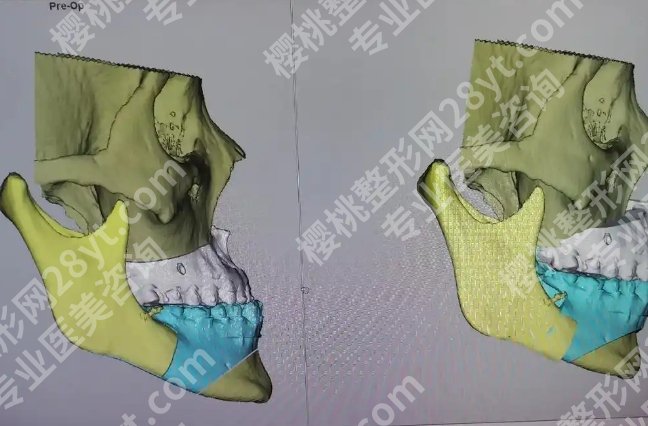 首口颏成型多少钱？院内人气医生推荐！