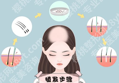 华中科技大学同济医院植发好吗？评价好！收费透明！实力推荐！