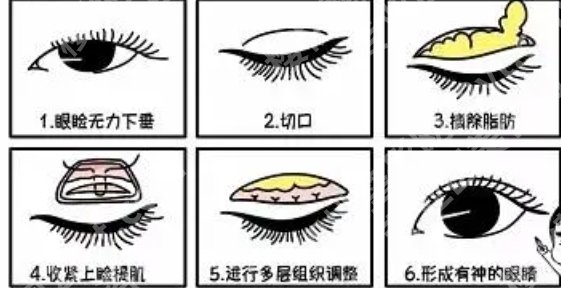 广州中医药大学第一附属医院双眼皮手术怎么样？技术点评