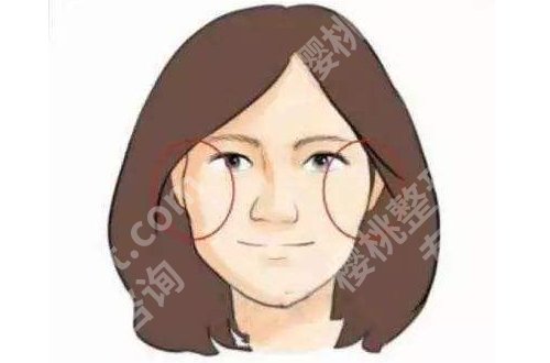 北京张笑天颧骨内推怎么样?医生介绍及案例更新!