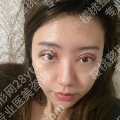 杭州范希玲双眼皮做的好吗?附核心项目、真实案例反馈!
