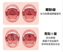 嘴唇整形手术价格贵不贵？科普篇等你了解
