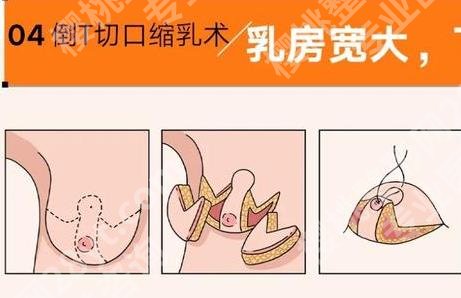 上海做缩胸手术好的医院分享！精选高人气机构名单分享！