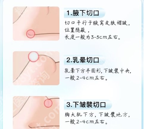 宁波腋下切口隆胸医院排名榜单汇总！个个实力强！