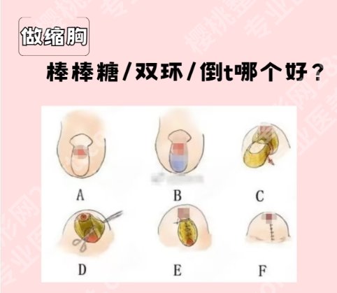 哈医大一院缩胸多少钱？医院实力点评|价目表参考！