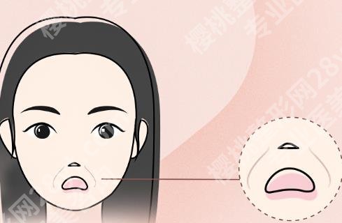 郑州张宛霞怎么样？玻尿酸填充去除法令纹案例鉴赏！