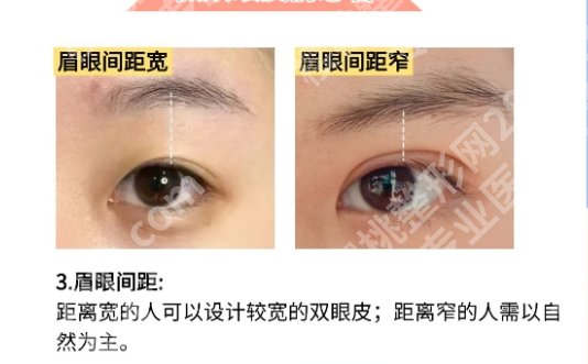 潍坊割双眼皮医生:王少华、梁晓琴、翟朝晖等，风格和技术各不相同！