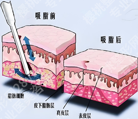 广州黄广香腹壁成形术多少钱？轻度腹壁整形手术30000元起