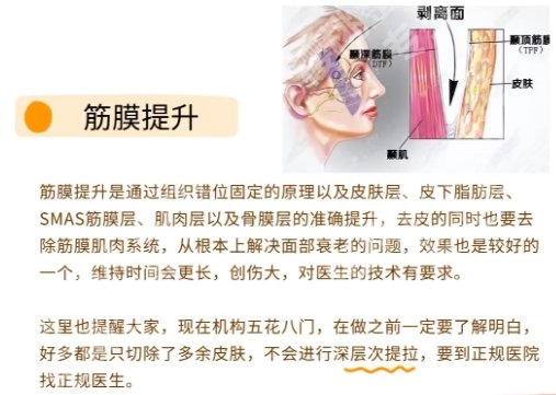 浙医二院筋膜悬吊手术费用刷新，21,800元起，技术优势等点评！