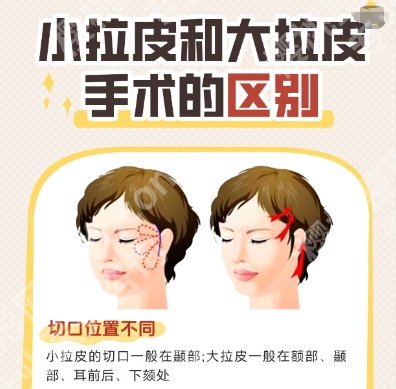 深圳美莱的拉美拉超声刀怎么样？医院口碑测评|案例图反馈！