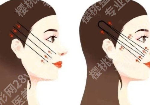 成都李烈做的筋膜提升怎么样？技术在线、实力详情曝光！