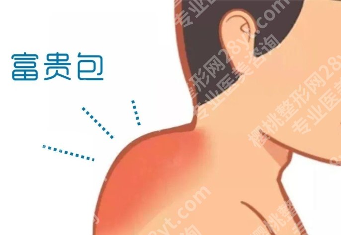 上海九院富贵包要几天?戳进来看真实的案例吧