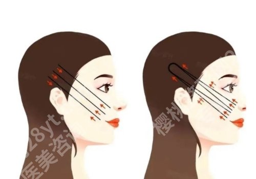 季滢医生筋膜提升怎么样?技术实力在线!优势公布!
