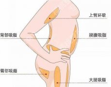 曹卫刚抽脂费用是不是很高？公布价格列表与医生资料分享