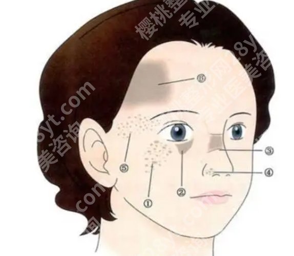 赵茹医生看胎记怎么样？真实的案例鉴赏！