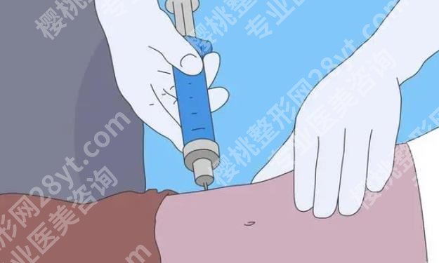 成都李烈吸脂案例图曝光!吸脂手术前后小贴士分享!