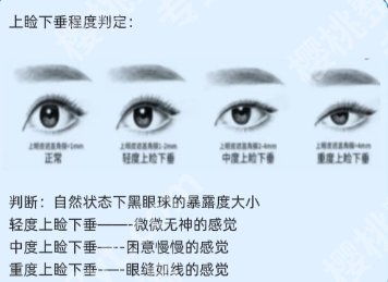 邢台割双眼皮机构有哪些？这些医院环境卫生超好附医生技术！