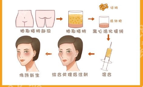福州哪个医院自体脂肪填充好？医院口碑好|实力出众！