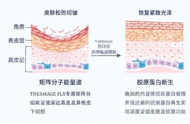 西京医院热玛吉是几代？热玛吉小常识分享！附费用表