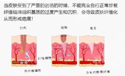 赵穆欣医生手术疤痕处理的怎么样？分享近期案例反馈！