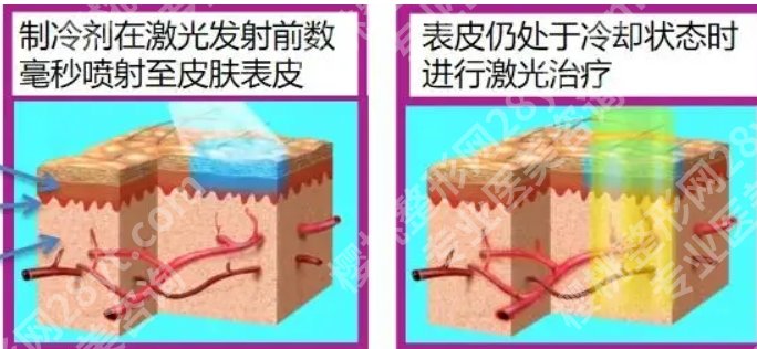 杭州三院点阵激光的技术好吗？优势分析！