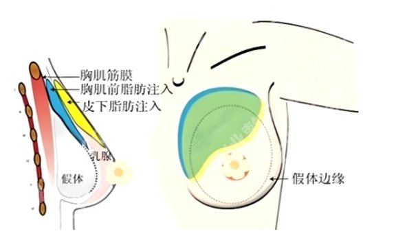 唐都医院假体隆胸怎么样？医院明星项目！案例鉴赏
