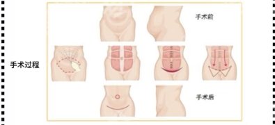 西京医院腹壁成型手术专家有哪些？医院详细资料介绍！用户口碑