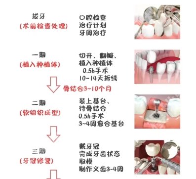 北京潞河医院种植牙价格贵不贵？2025收费标准更新！