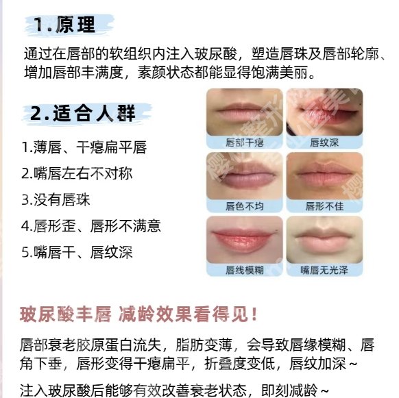 南京玻尿酸丰唇手术的价格！基础价格低至3800元！附口碑医院TOP