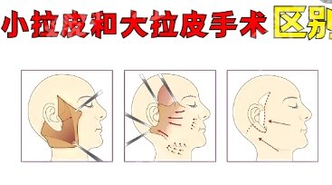 杨大平和李晓东谁的面部提升更好？对比口碑都是有名的医生！