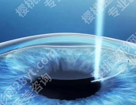 中山做近视眼手术价格是多少？查看价格明细_案例详情分享
