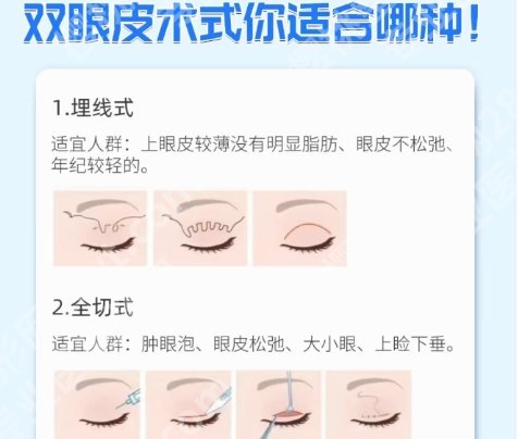 郑州割双眼皮口碑好医生有哪些？分享几位医生的具体资料！
