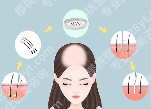 小榄人民医院整形科可以做植发吗？一览详情介绍