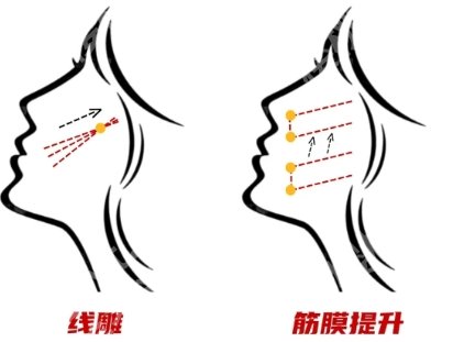 南方医院筋膜悬吊价格是多少？这份变美攻略记得查收！