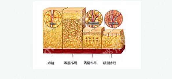 北医三院抽脂哪个医医生好？医生力量雄厚！项目价格表参考