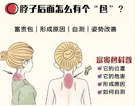 上海九院做富贵包好吗？医院具体相关信息！附案例分享
