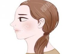 苹果肌复位做什么项目好？注意事项大公开