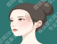 双美胶原蛋白打几次定型？不同部位打法也不一样