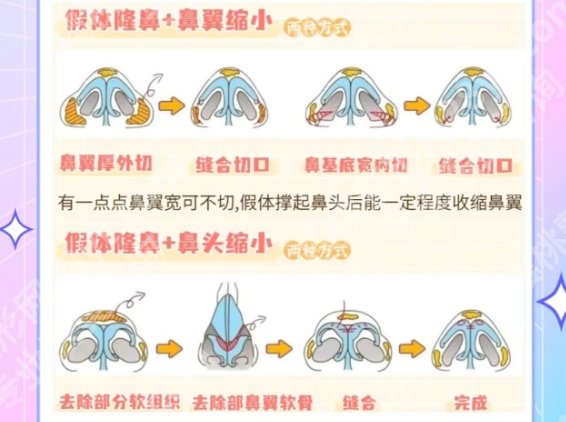 重医附一院假体隆鼻多少钱？医院医生技术水平优势！
