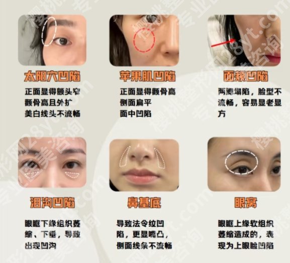 李光琴医生技术怎么样？医生简介及近期脂肪填充案例图展示！