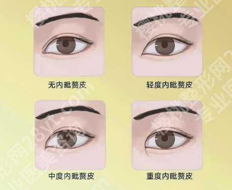 天津割双眼皮哪家医院好？医院实力不容小觑！反馈良好