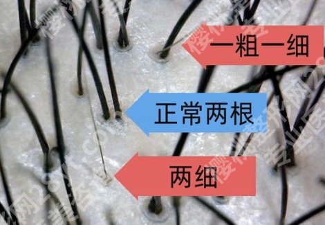马鞍山植发医院哪家比较好呢？医院技术杠杠给力！