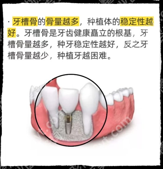温州牙齿种植公立医院哪家好？?温州市人民医院|医科大学附属口腔等医院技术靠谱！