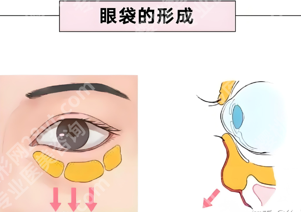 南京中大医院祛眼袋多少钱？外切去眼袋2212元起