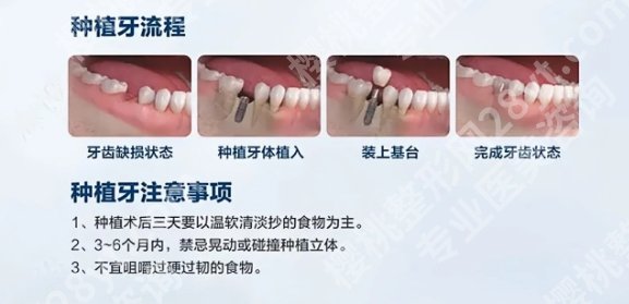 厦门牙齿种植医院排名更新啦！下文都是实力靠谱的医疗机构！点击查询