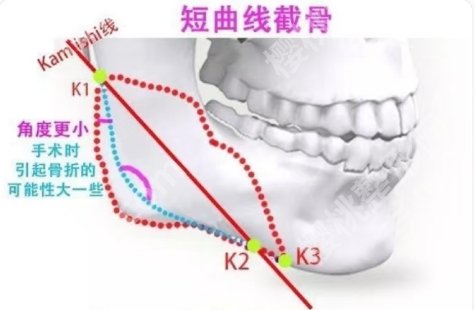 广医一附院磨骨手术价格是多少？是很有实力的公立综合医院！
